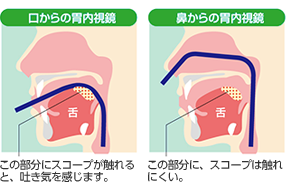 口からの胃内視鏡：この部分にスコープが触れると吐き気を感じます。/鼻からの胃内視鏡：この部分にスコープは触れにくい。